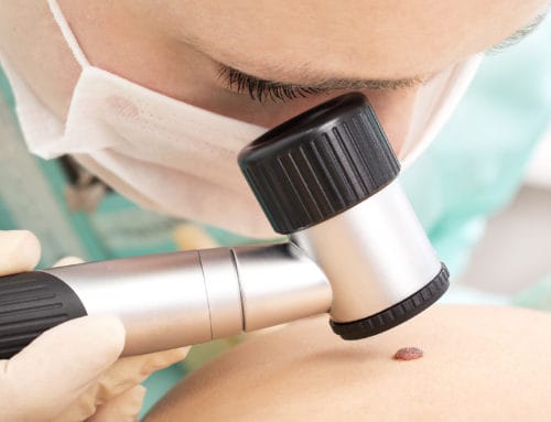 Cosmetic Mole Removal