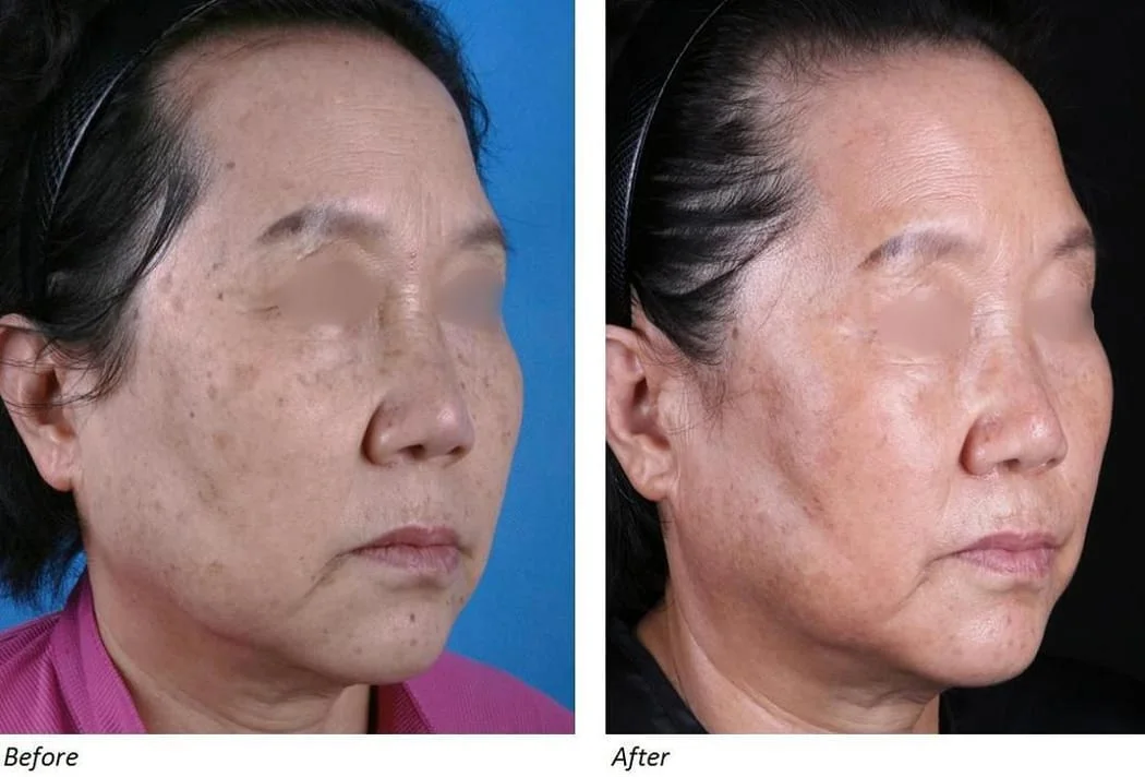 Before and after