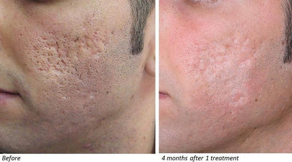Fractional Co2 Laser Scar Removal YDSF