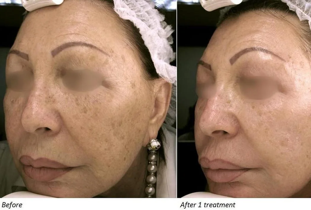 Before and after