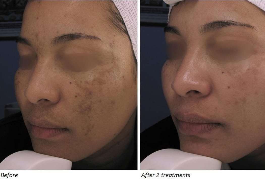 How To Treat Sun Spots And Age Spots With Laser Skin Therapy Eve