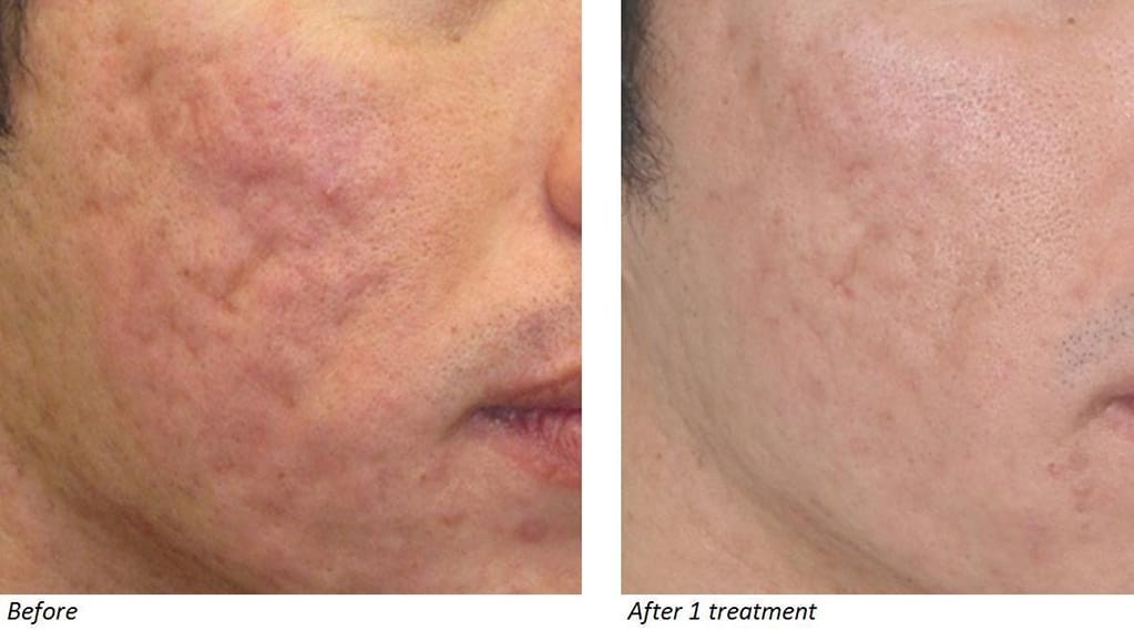 Acne Scar Treatment With CO2 Laser