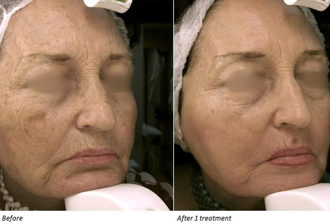 Before and after