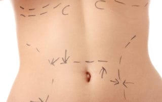 Stretch marks removal