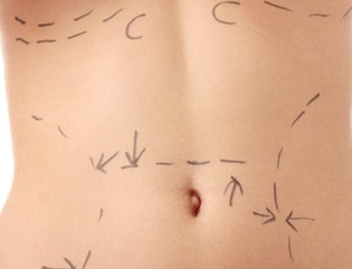 Scar Removal Leamington Spa