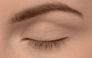 Xanthelasma