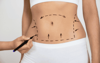 tummy tuck