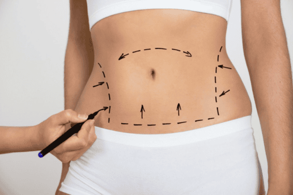 Tummy tuck skin tightening laser therapy - Eve Clinics Leamington Spa