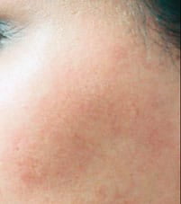 After Laser Hair removal on side of face