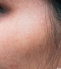 LHR-B-3 Before Laser Hair removal on side of face