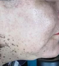 Mole 2 A