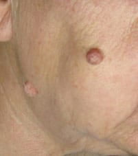 Mole 3 B