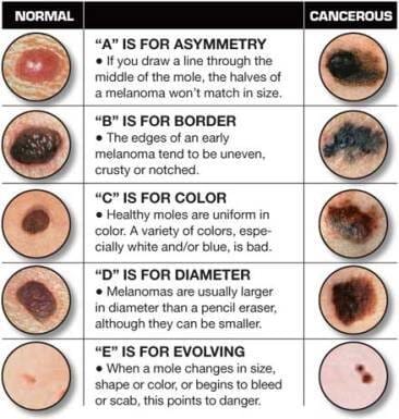 ABCDE - Easy guide to checking your moles