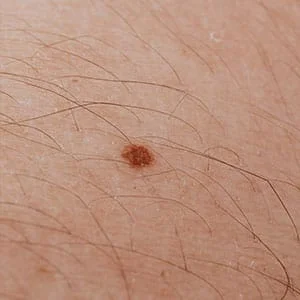 mole laser removal icon