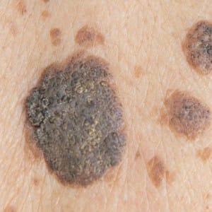 KERATOSIS