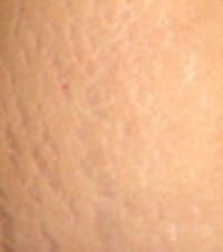 Stretch Marks B
