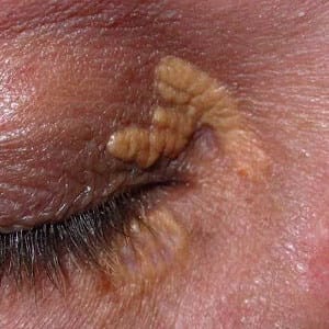 XANTHELASMA