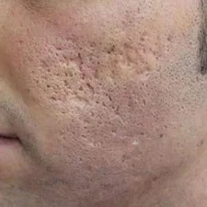 ACNE