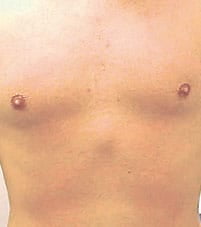 After laser hair removal on chest
