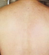 After laser hair removal on back