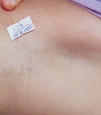 After laser hair removal on underarm