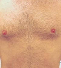 Before laser hair removal on chest