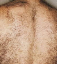 Before laser hair removal on back