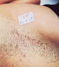 Before laser hair removal on underarm