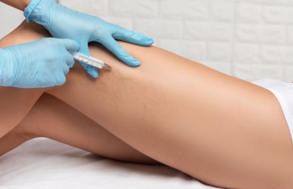 Vein Treatments