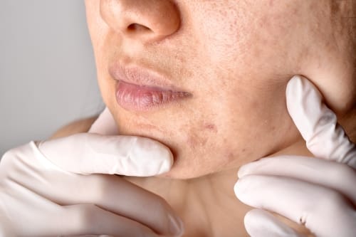 Acne Scar Removal