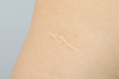 Scar Removal