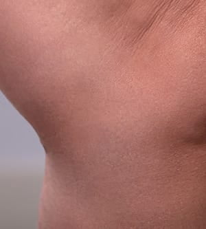 Thread Vein Removal - After