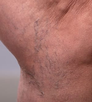 Thread Vein Removal - Before