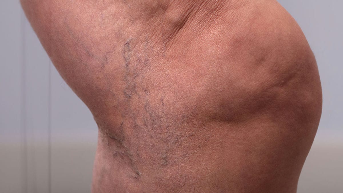 Thread Vein Removal