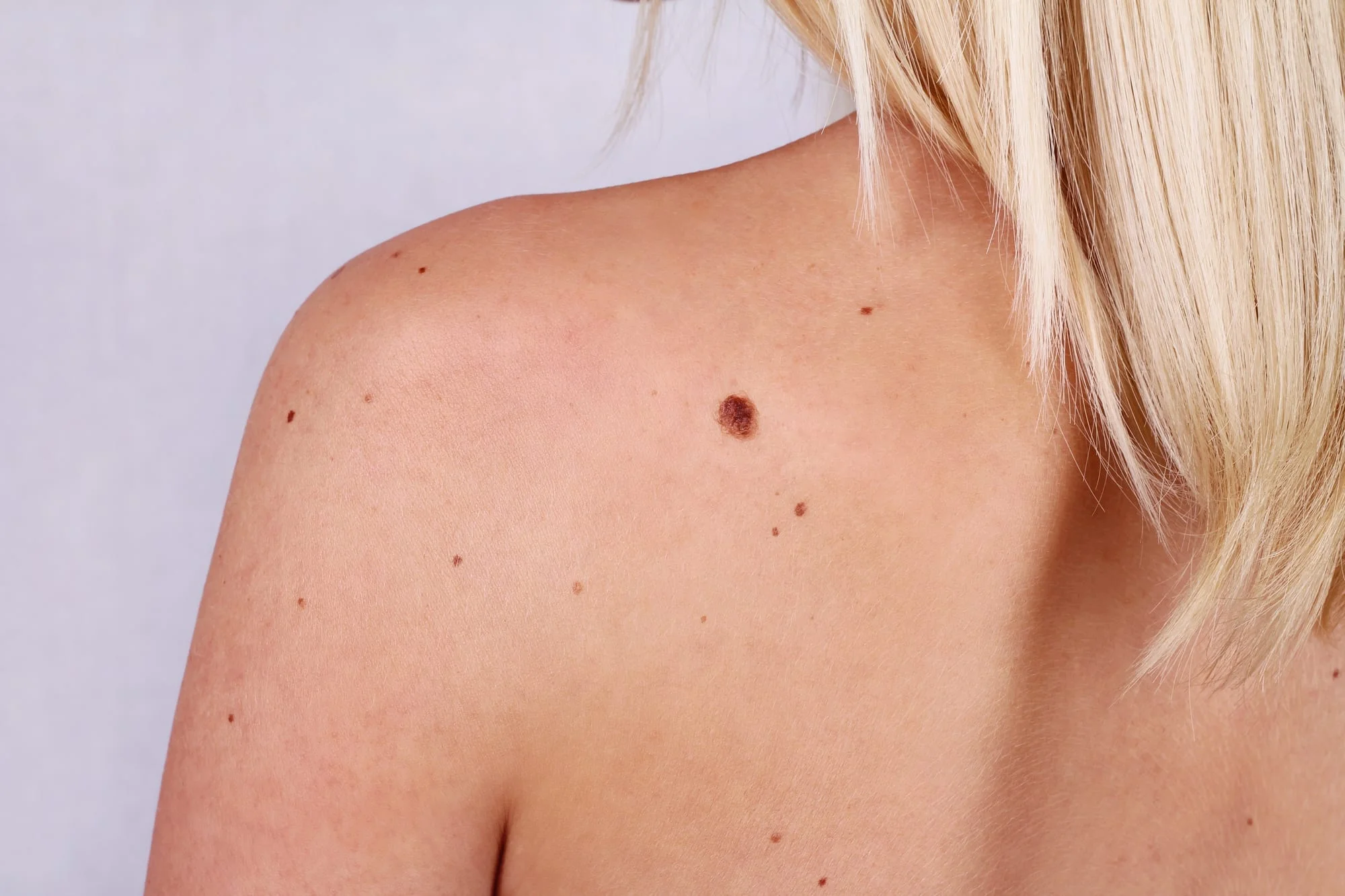 the importance of expert mole checks