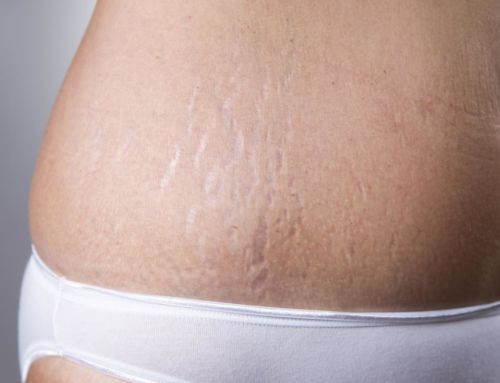 The Causes of Stretch Marks