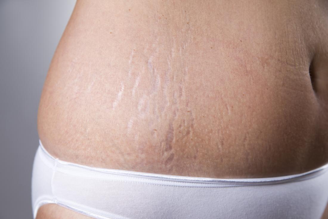 what causes stretch marks