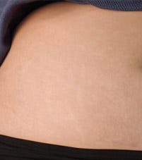 stretch marks 1 a