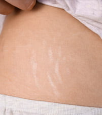 stretch marks 1 b