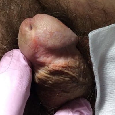 penile scar after