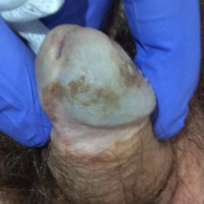penile scar before