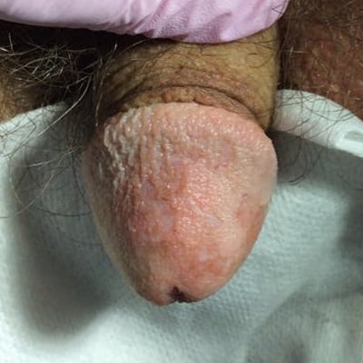 penis scar after