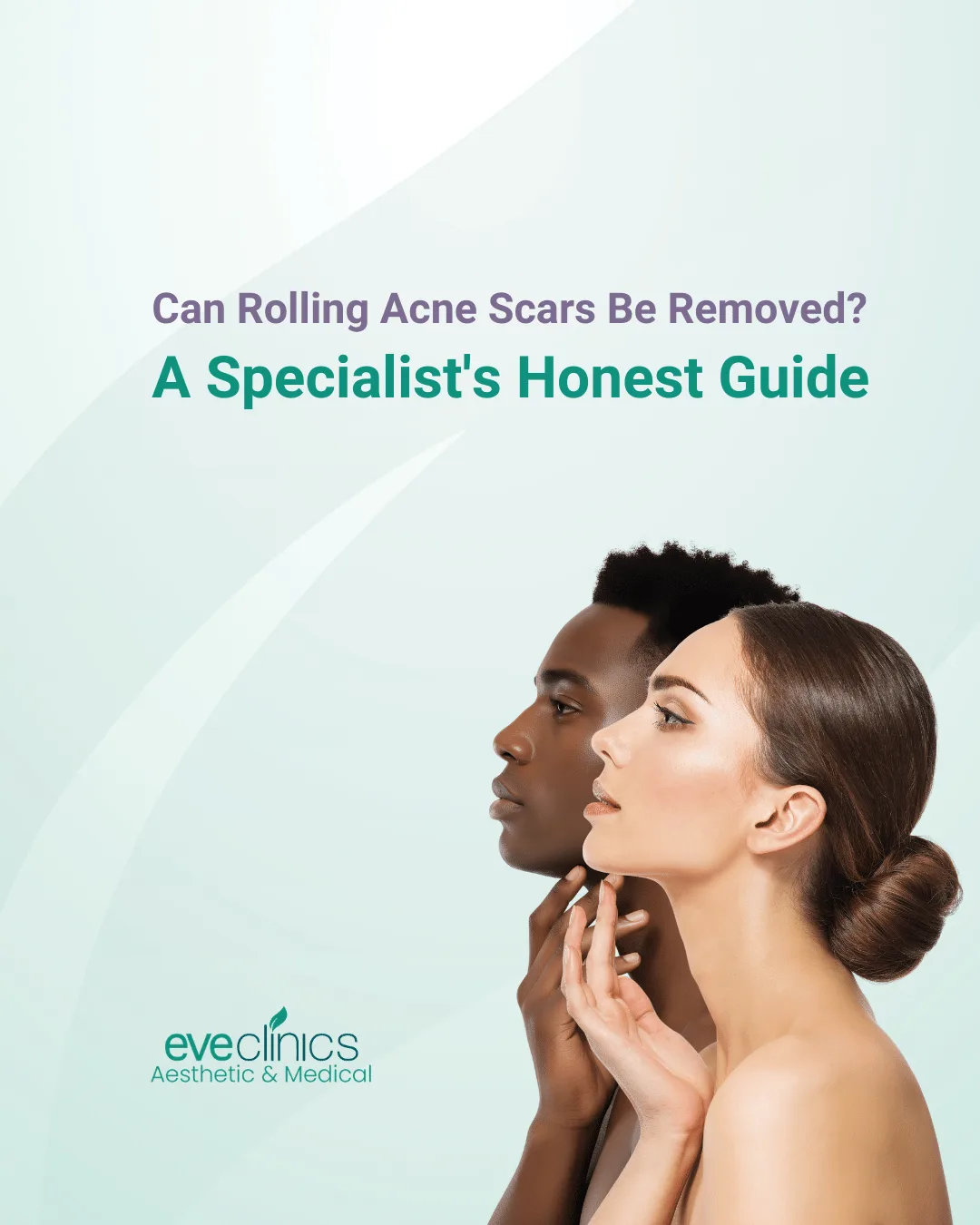 can rolling acne scars be removed