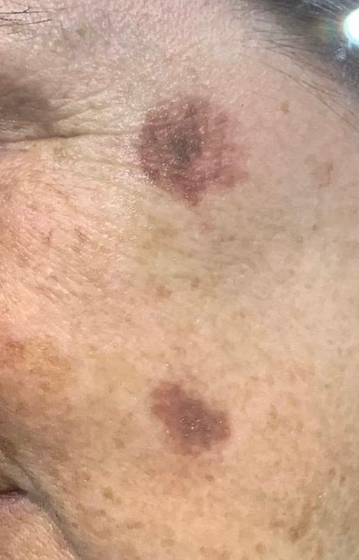 sun damage removal before